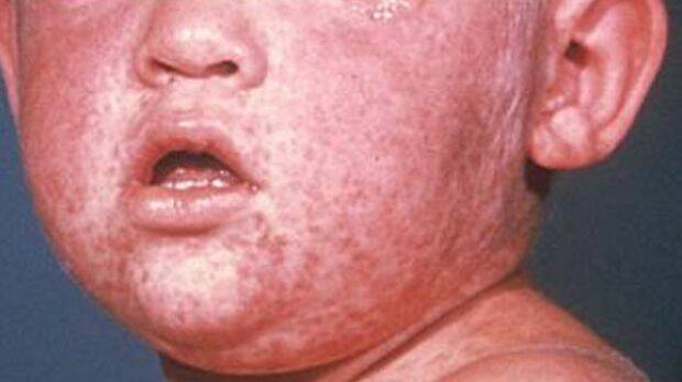 The measles rash on the face of a child. Photo: Centres for Disease Control and Prevention
