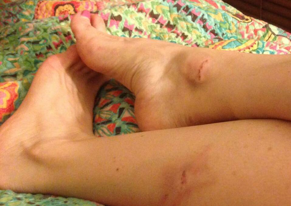 BITES: Jenny Barber says these wounds came from a dog off its leash near One Tree Hill. Picture: CONTRIBUTED