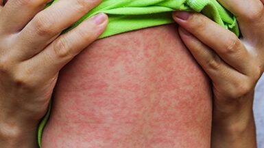 Measles alert for Bendigo and Heathcote areas