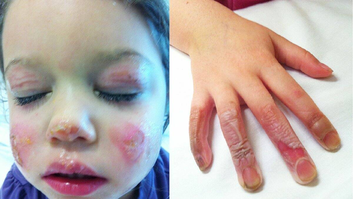 SCARRED: Ava Lyons suffered severe burns to her hand and face after a portable DVD player caught fire while she was travelling in the family car.